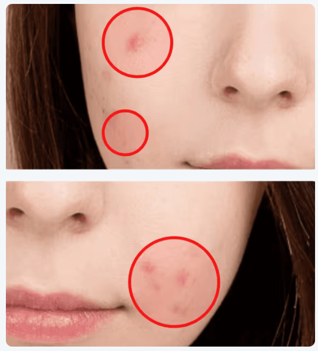 Aragon Blemish Remover