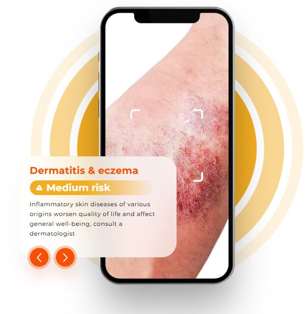 Skinive dermatitis and eczema medium risk detection example