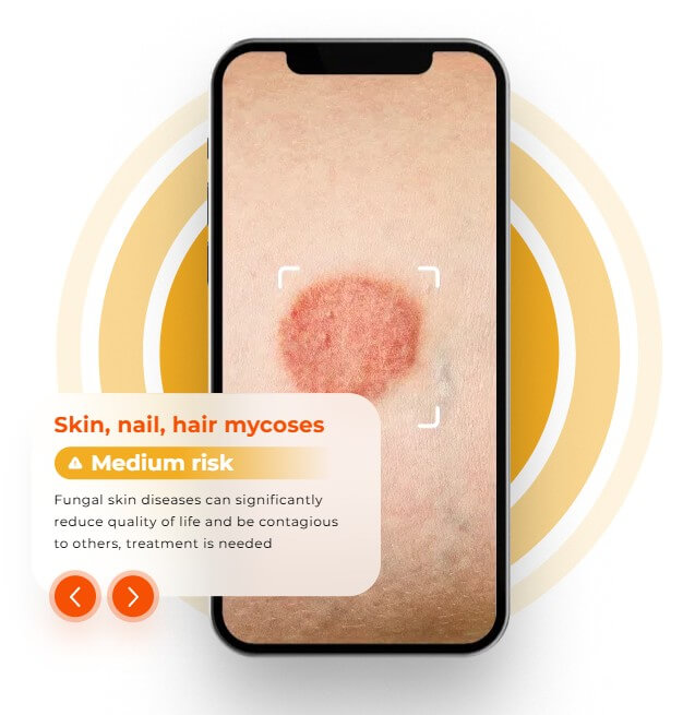 Skinive skin nail and hair mycoses medium risk detection example